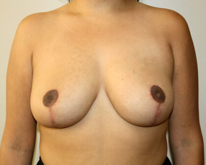 Breast Reduction Before & After Patient #2350