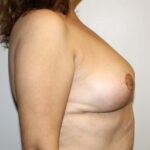 Breast Reduction Before & After Patient #2371