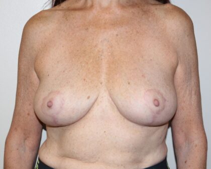 Breast Implant Removal Before & After Patient #2312