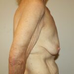 Breast Augmentation Before & After Patient #2334