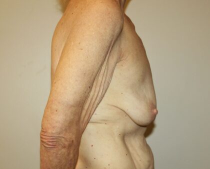 Breast Augmentation Before & After Patient #2334