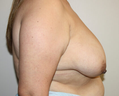 Breast Reduction Before & After Patient #2385