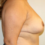 Breast Reduction Before & After Patient #2385