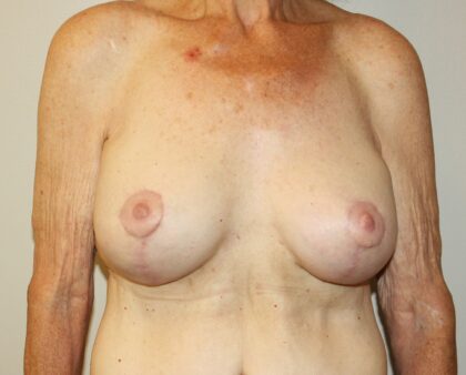 Breast Augmentation Before & After Patient #2334