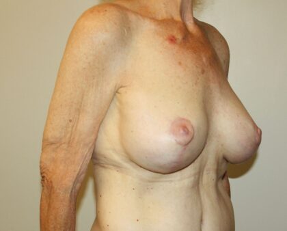 Breast Augmentation Before & After Patient #2334