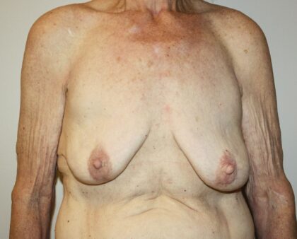 Breast Augmentation Before & After Patient #2334