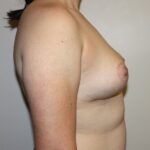 Breast Lift Before & After Patient #2326