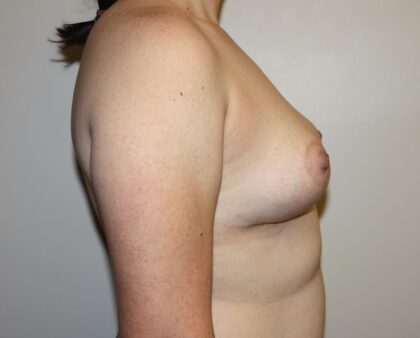 Breast Lift Before & After Patient #2326