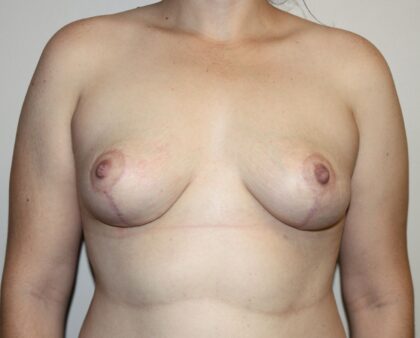 Breast Lift Before & After Patient #2326