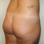 Brazilian Butt Lift Before & After Patient #2299