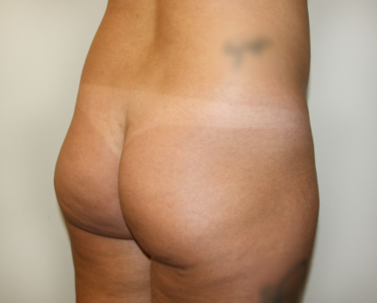 Brazilian Butt Lift Before & After Patient #2299