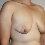 Breast Lift Before & After Patient #2326