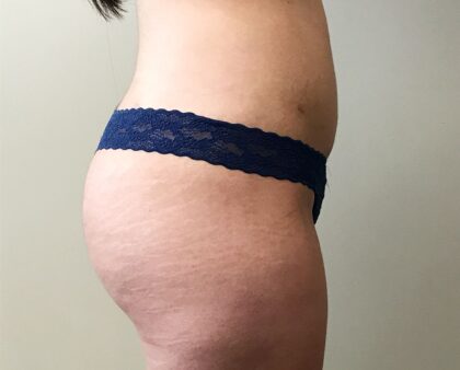 Brazilian Butt Lift Before & After Patient #2292