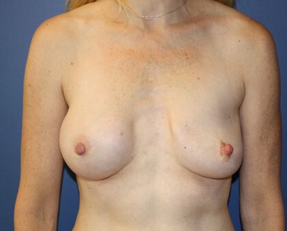 Breast Revision Before & After Patient #2319