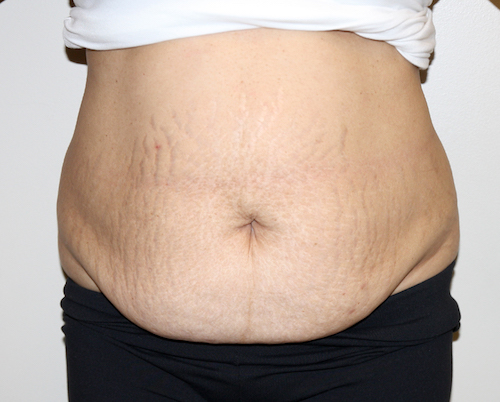 Tummy Tuck Before & After Patient #2540