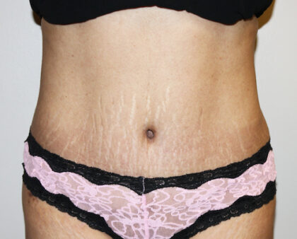 Tummy Tuck Before & After Patient #2540