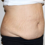 Tummy Tuck Before & After Patient #2540