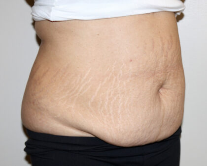 Tummy Tuck Before & After Patient #2540