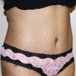 Tummy Tuck Before & After Patient #2540