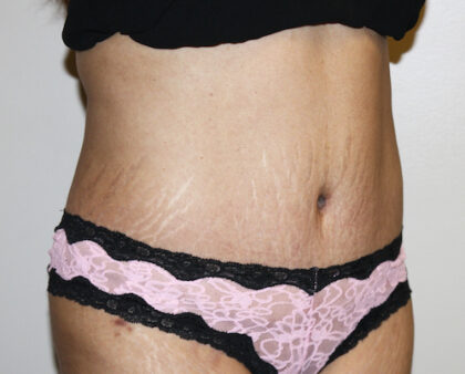 Tummy Tuck Before & After Patient #2540