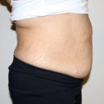Tummy Tuck Before & After Patient #2540
