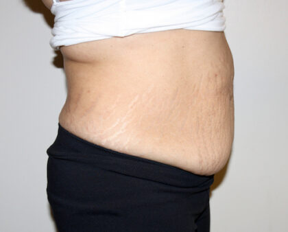 Tummy Tuck Before & After Patient #2540