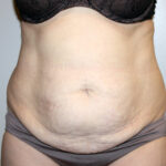 Tummy Tuck Before & After Patient #2547