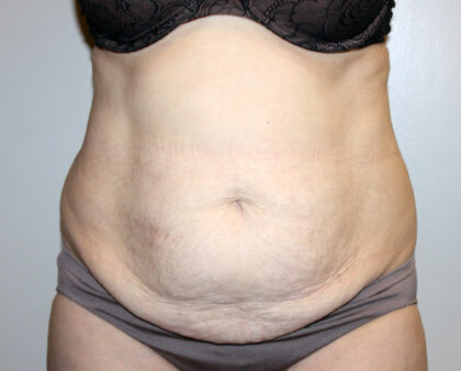 Tummy Tuck Before & After Patient #2547