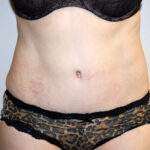 Tummy Tuck Before & After Patient #2547