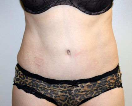 Tummy Tuck Before & After Patient #2547