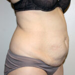 Tummy Tuck Before & After Patient #2547