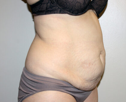 Tummy Tuck Before & After Patient #2547