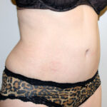 Tummy Tuck Before & After Patient #2547