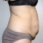 Tummy Tuck Before & After Patient #2547