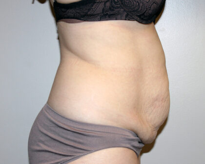 Tummy Tuck Before & After Patient #2547