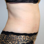 Tummy Tuck Before & After Patient #2547