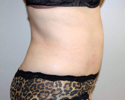 Tummy Tuck Before & After Patient #2547