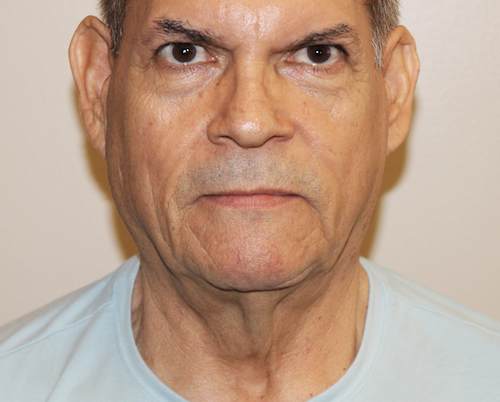 Facelift Before & After Patient #2440