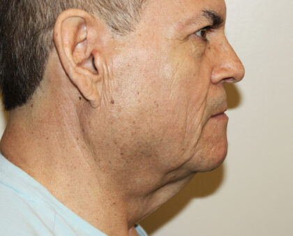 Facelift Before & After Patient #2440