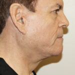 Facelift Before & After Patient #2440