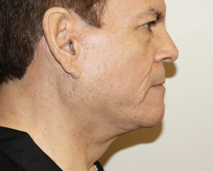 Facelift Before & After Patient #2440