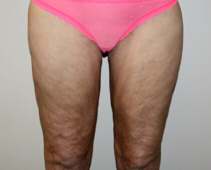 Thigh Lift Before & After Patient #2518
