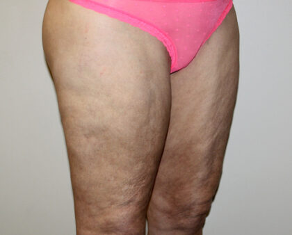 Thigh Lift Before & After Patient #2518