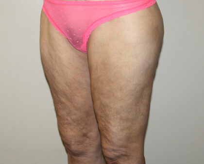 Thigh Lift Before & After Patient #2518