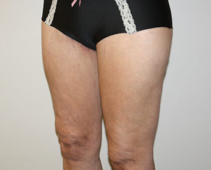 Thigh Lift Before & After Patient #2518