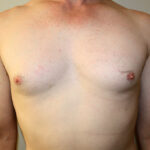 Gynecomastia Before & After Patient #2461