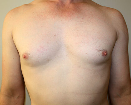 Gynecomastia Before & After Patient #2461