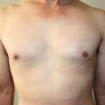 Gynecomastia Before & After Patient #2461