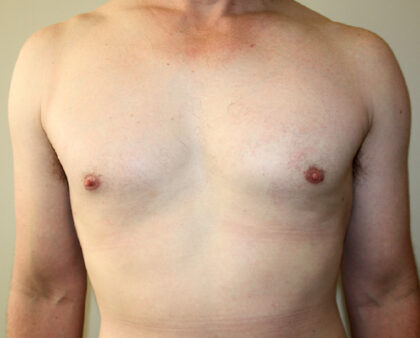 Gynecomastia Before & After Patient #2461