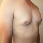 Gynecomastia Before & After Patient #2461